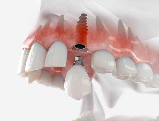 Dental Implant Arlington, TX